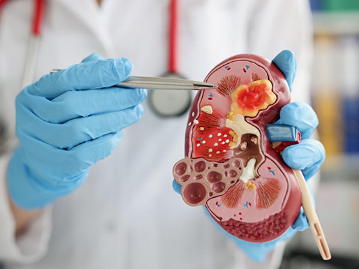 🩺 ¿Por qué la diabetes causa daño renal?